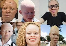 World Cancer Day: NGO Seeks Support For Persons With Albinism Battling Cancer